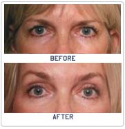 Fore Head Lift Brow Lift Surgery In India